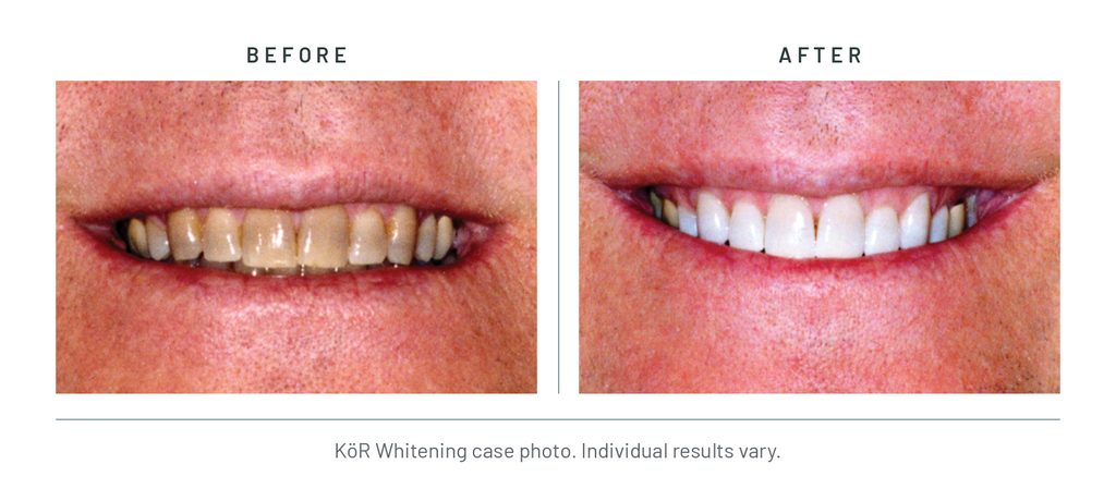 KöR Whitening case photo, before and after