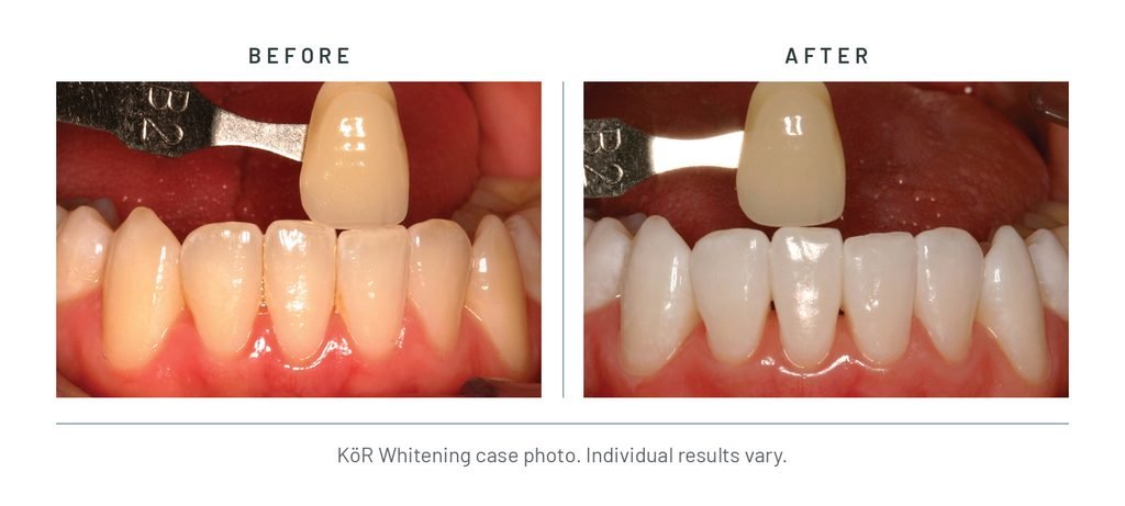 KöR Whitening case photo, before and after