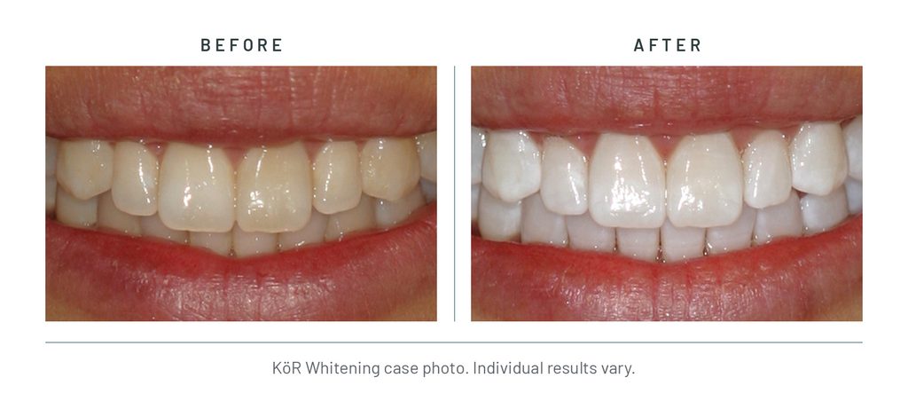 KöR Whitening case photo, before and after